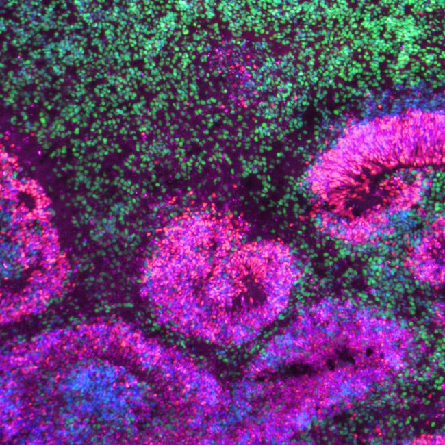 Dense fluorescent tissue with swirling pink rosette structures and green cells.