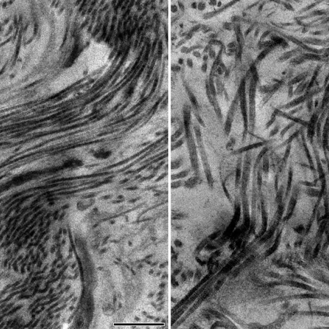 Electron microscopy images showing a healthy scar containing collagen type 5 with scar fibers smoothly arranged in parallel (left) and unhealthy scar containing no collagen type 5 with a disorganized architecture with disarray of scar fibers (right).