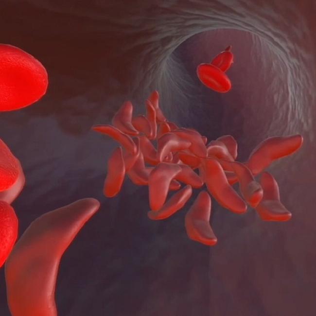 A mix of healthy red blood cells and misshapen cells caused by sickle cell disease. These sickle-shaped cells can clog arteries, producing a range of serious health effects.